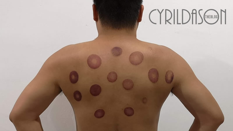 Cupping Therapy in Kuching